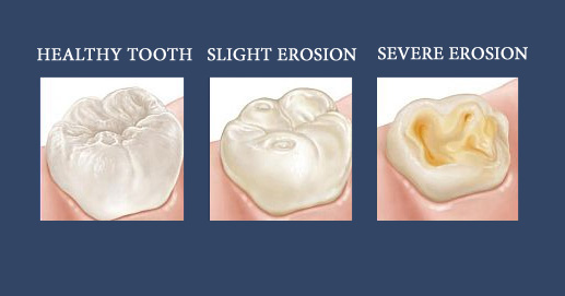 Dental Erosion – mybetterdentists