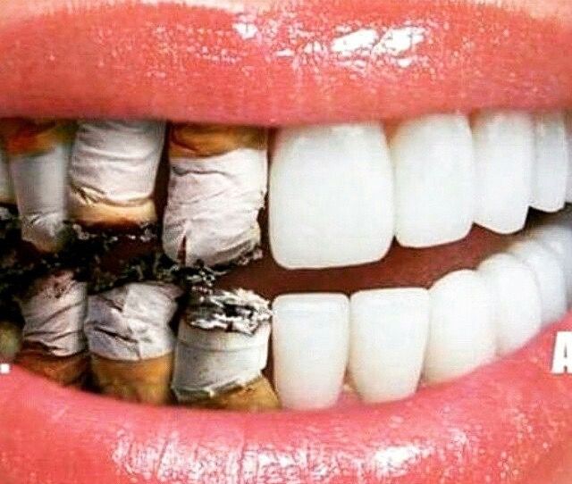 Dampak Buruk Merokok Bagi Kesehatan Gigi- Global Estetik Dental Care